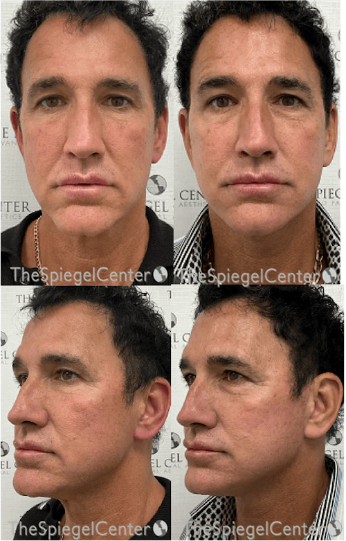 Facelift Before & After Gallery - Patient 236681 - Image 1