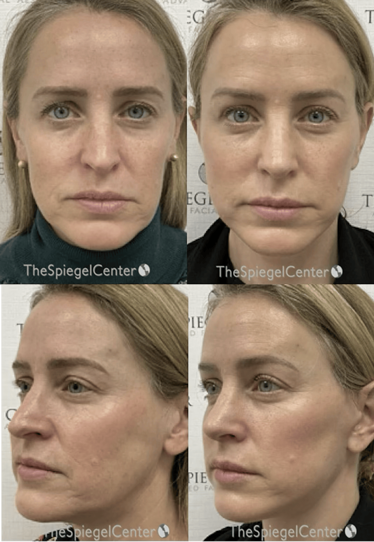 Facelift Before & After Gallery - Patient 358435 - Image 1