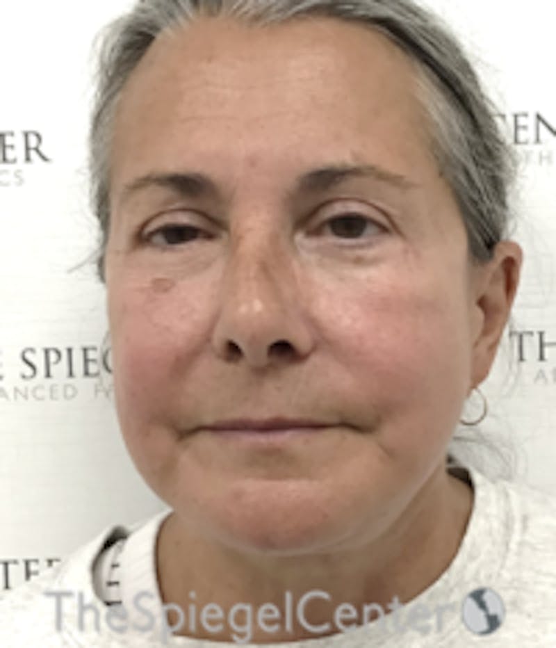Facelift Before & After Gallery - Patient 211060 - Image 2