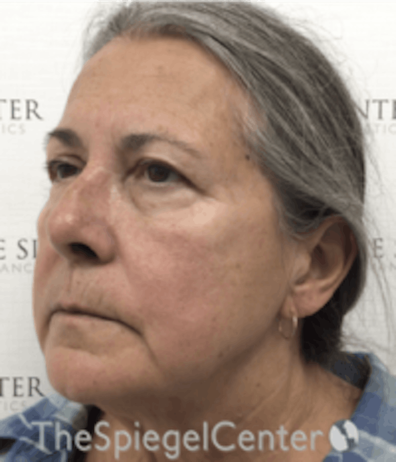 Facelift Before & After Gallery - Patient 211060 - Image 3