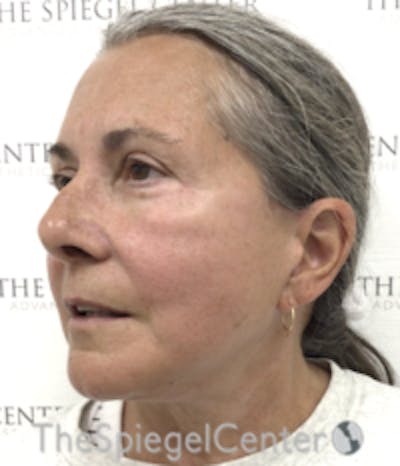 Facelift Before & After Gallery - Patient 211060 - Image 4