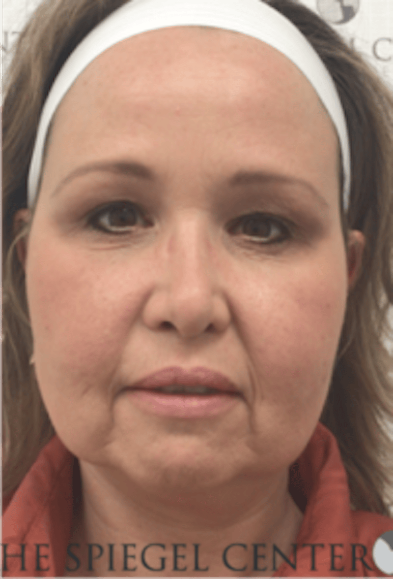 Facelift Before & After Gallery - Patient 119538 - Image 1