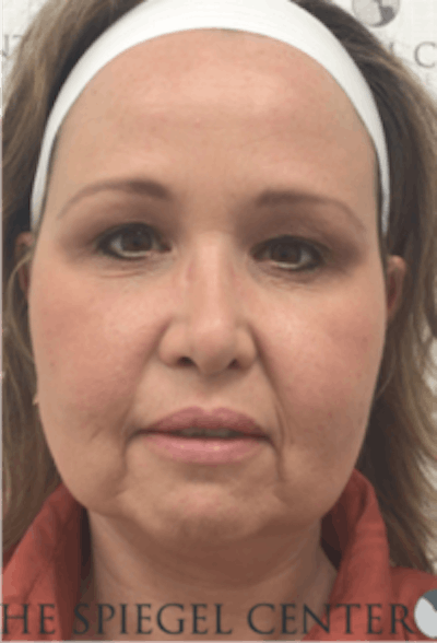 Facelift Before & After Gallery - Patient 119538 - Image 1