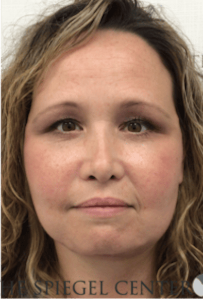 Facelift Before & After Gallery - Patient 119538 - Image 2