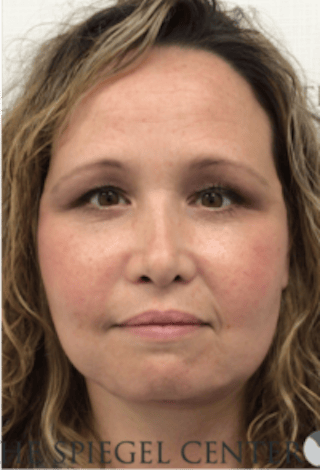 Facelift Before & After Gallery - Patient 119538 - Image 2