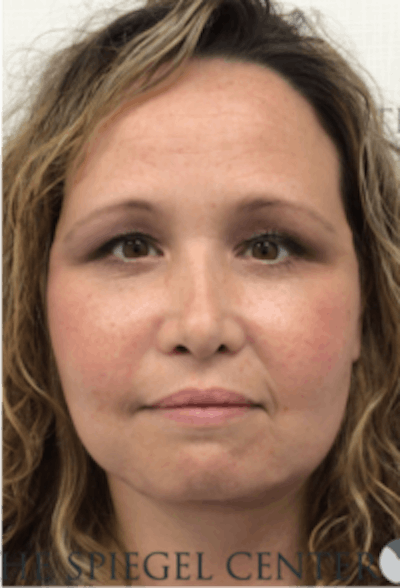 Facelift Before & After Gallery - Patient 119538 - Image 2
