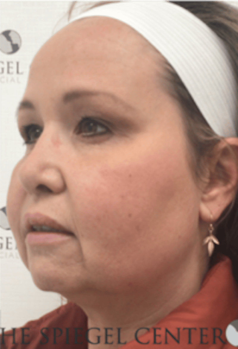 Facelift Before & After Gallery - Patient 119538 - Image 3