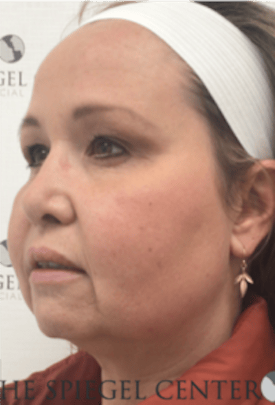 Facelift Before & After Gallery - Patient 119538 - Image 3