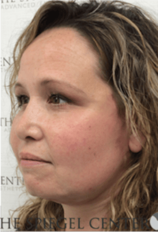 Facelift Before & After Gallery - Patient 119538 - Image 4