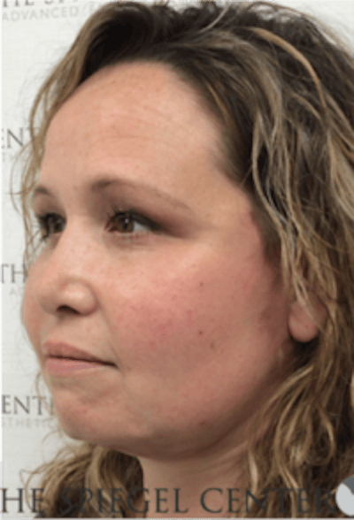 Facelift Before & After Gallery - Patient 119538 - Image 4