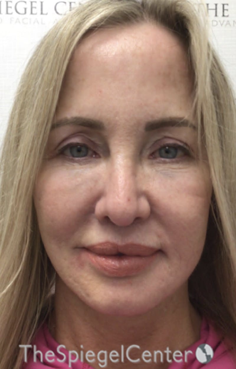 Facelift Before & After Gallery - Patient 424050 - Image 1
