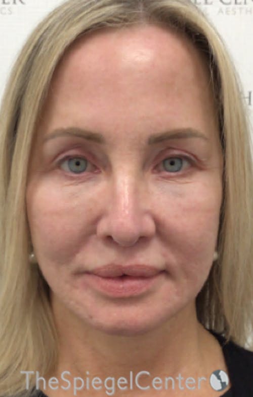 Facelift Before & After Gallery - Patient 424050 - Image 2
