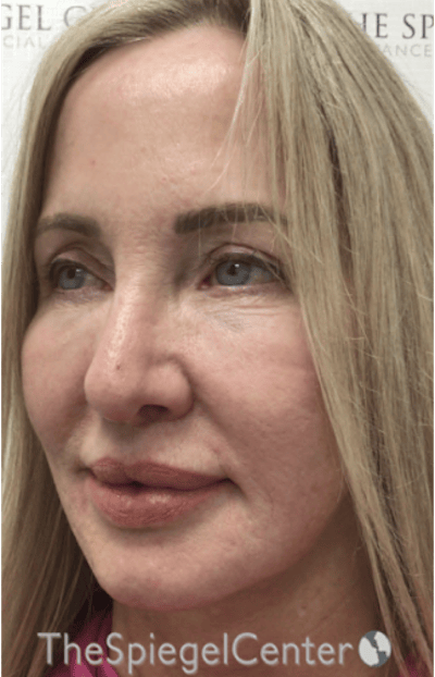 Facelift Before & After Gallery - Patient 424050 - Image 3