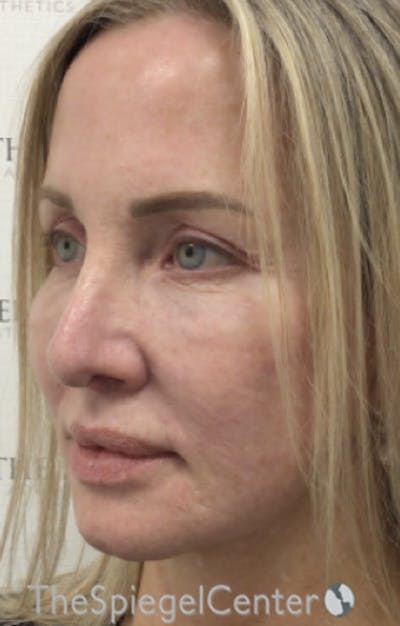 Facelift Before & After Gallery - Patient 424050 - Image 4