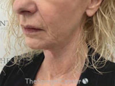Facelift Before & After Gallery - Patient 189952 - Image 2