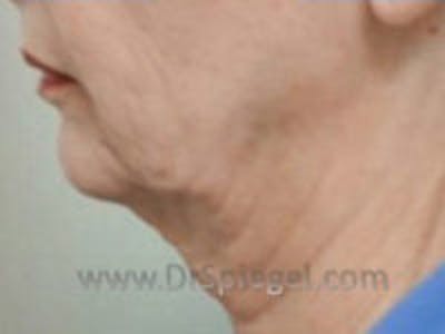 Facelift Before & After Gallery - Patient 189952 - Image 3