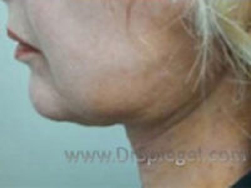 Facelift Before & After Gallery - Patient 189952 - Image 4