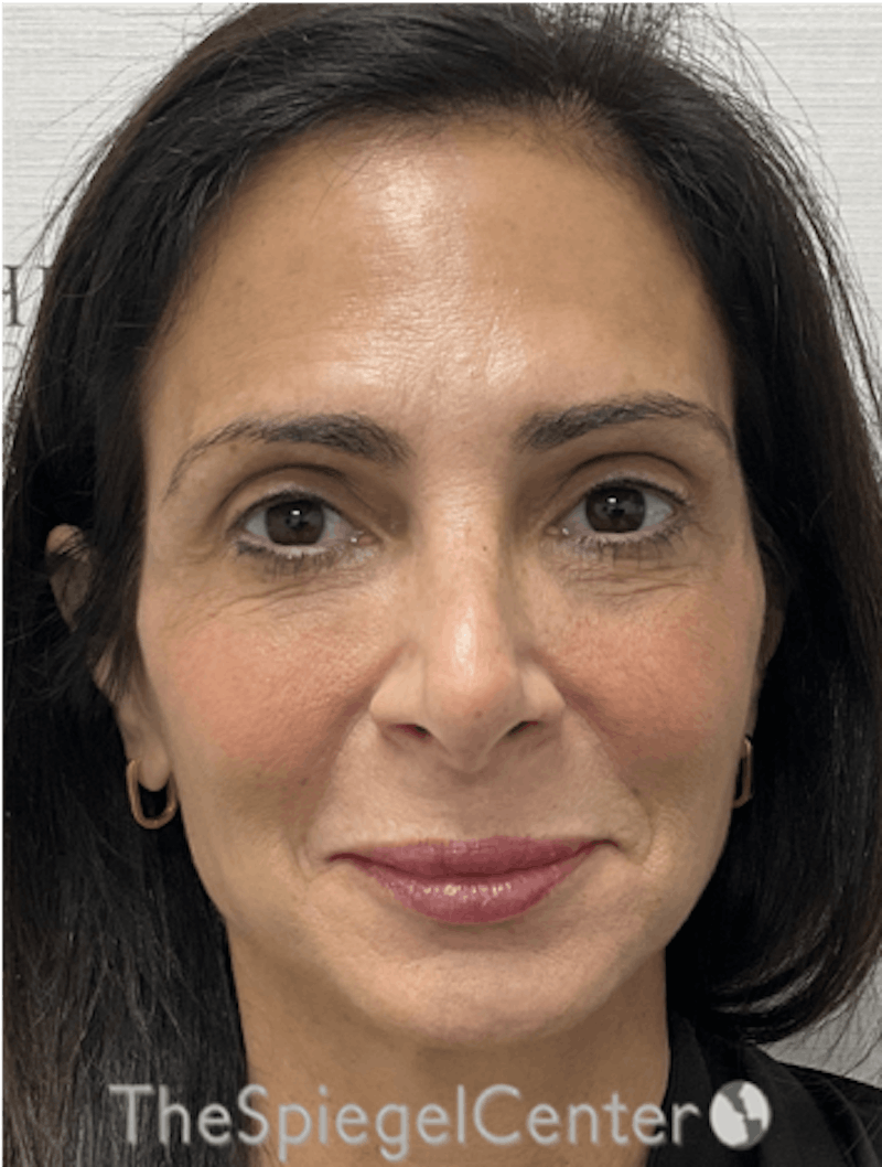 Facelift Before & After Gallery - Patient 131655 - Image 1