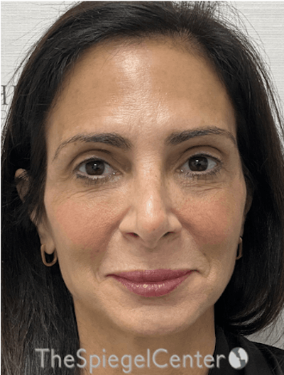 Facelift Before & After Gallery - Patient 131655 - Image 1