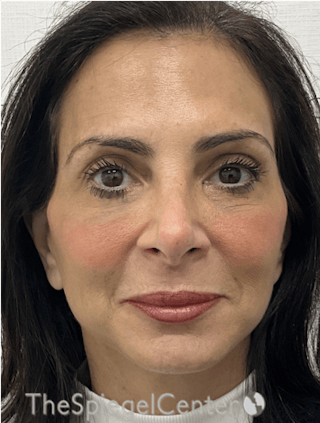 Facelift Before & After Gallery - Patient 131655 - Image 2