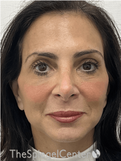 Facelift Before & After Gallery - Patient 131655 - Image 2