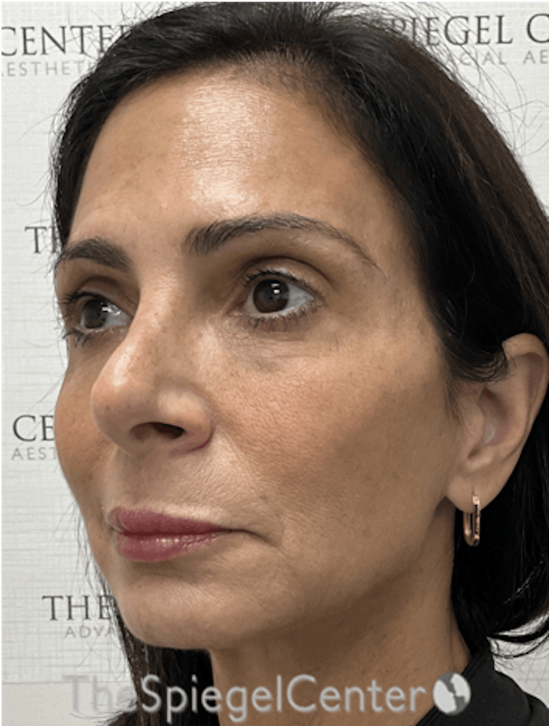 Facelift Before & After Gallery - Patient 131655 - Image 3