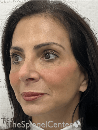 Facelift Before & After Gallery - Patient 131655 - Image 4