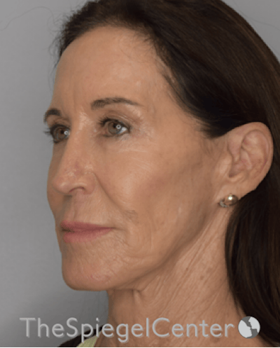 Facelift Before & After Gallery - Patient 857757 - Image 3