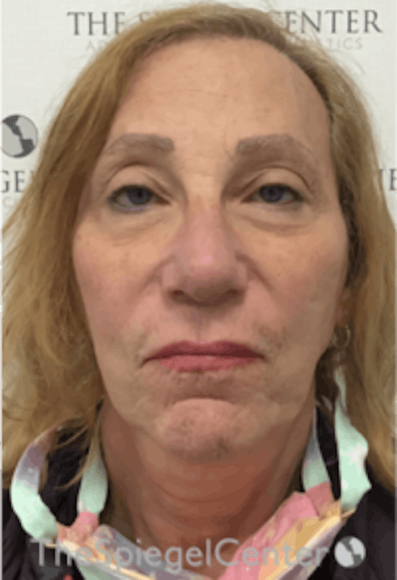 Facelift Before & After Gallery - Patient 227067 - Image 1