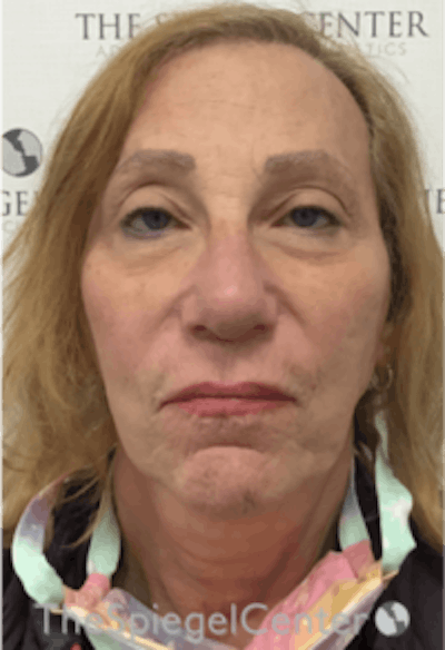 Facelift Before & After Gallery - Patient 227067 - Image 1