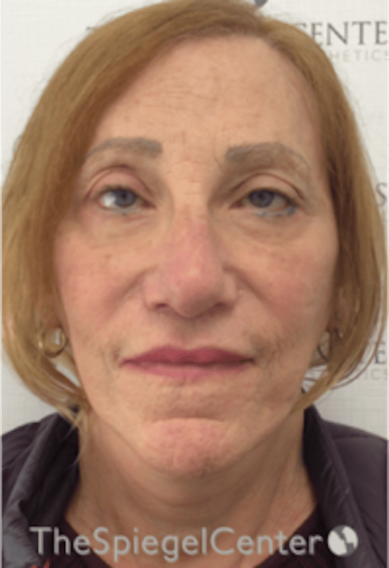 Facelift Before & After Gallery - Patient 227067 - Image 2