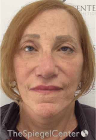 Facelift Before & After Gallery - Patient 227067 - Image 2
