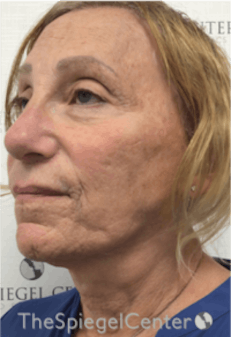 Facelift Before & After Gallery - Patient 227067 - Image 3