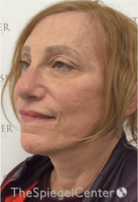 Facelift Before & After Gallery - Patient 227067 - Image 4
