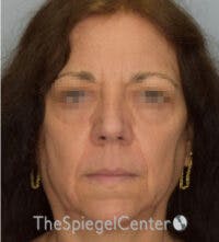 Facelift Before & After Gallery - Patient 361330 - Image 1