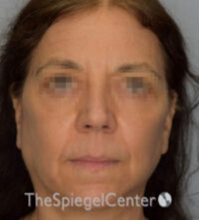 Facelift Before & After Gallery - Patient 361330 - Image 2