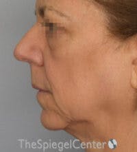 Facelift Before & After Gallery - Patient 361330 - Image 3