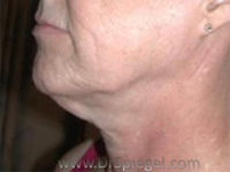 Neck Lift Before & After Gallery - Patient 779245 - Image 1