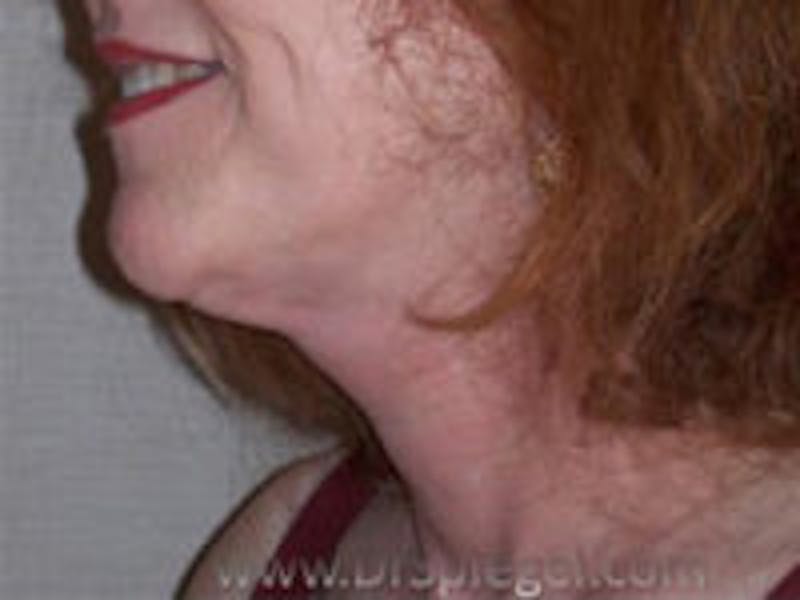 Neck Lift Before & After Gallery - Patient 779245 - Image 2