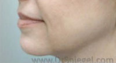Facelift Before & After Gallery - Patient 265628 - Image 1