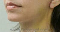 Neck Lift Before & After Gallery - Patient 270306 - Image 2