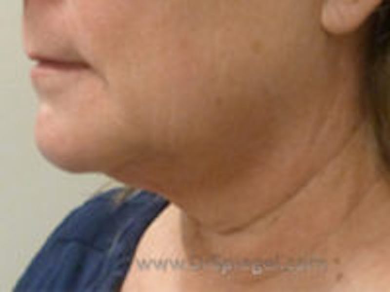 Neck Lift Before & After Gallery - Patient 386019 - Image 1