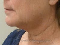 Facelift Before & After Gallery - Patient 984426 - Image 1