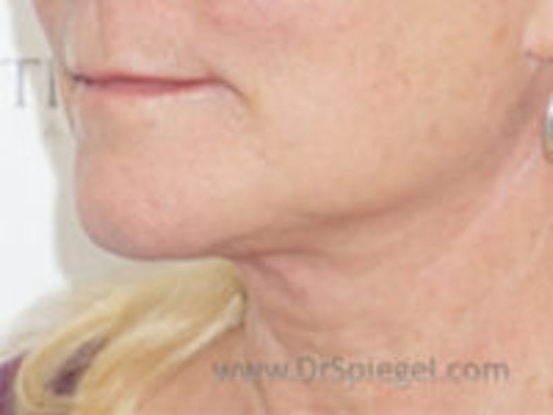 Neck Lift Before & After Gallery - Patient 386019 - Image 2