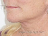 Facelift Before & After Gallery - Patient 984426 - Image 2