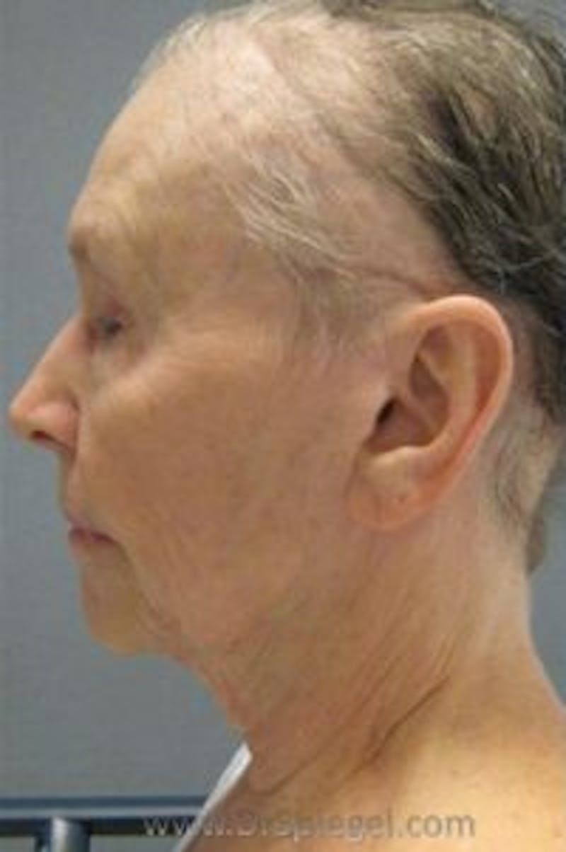Facelift Before & After Gallery - Patient 142936 - Image 1