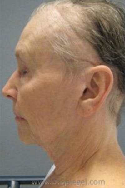 Facelift Before & After Gallery - Patient 142936 - Image 1