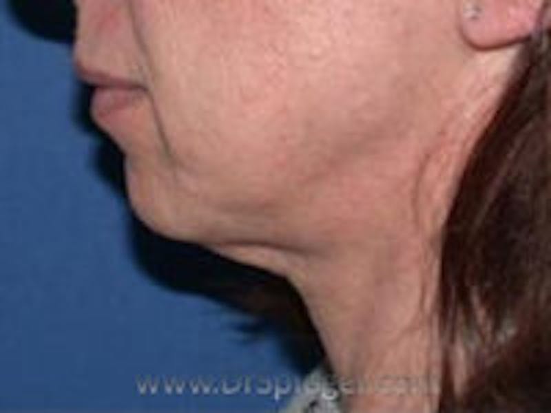 Neck Lift Before & After Gallery - Patient 175033 - Image 1