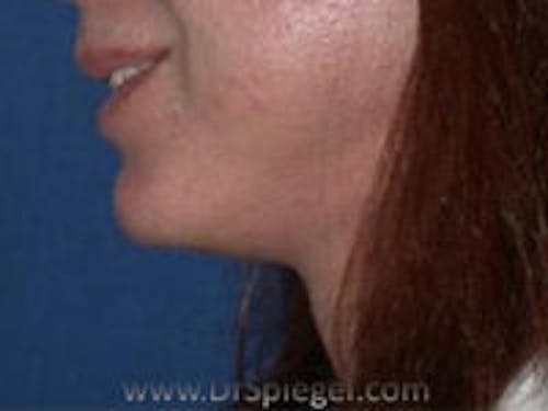 Neck Lift Before & After Gallery - Patient 175033 - Image 2
