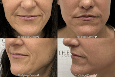 Facial Fat Grafting Before & After Gallery - Patient 377520 - Image 1